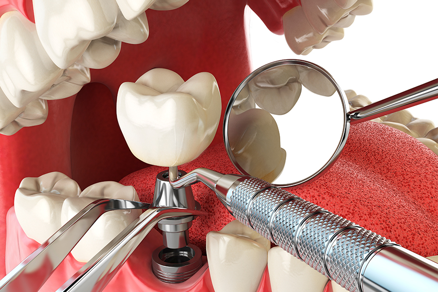 tipos de implante dentário